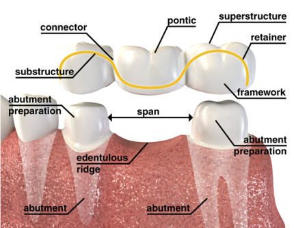 Discount dental crowns Clearance